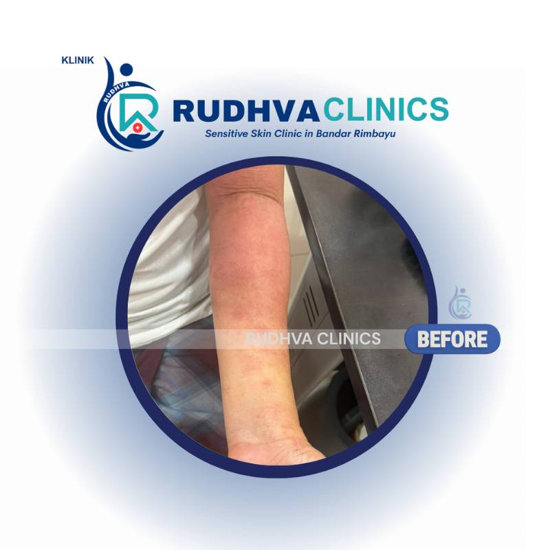 RUDHVA - Allergy Services (1)