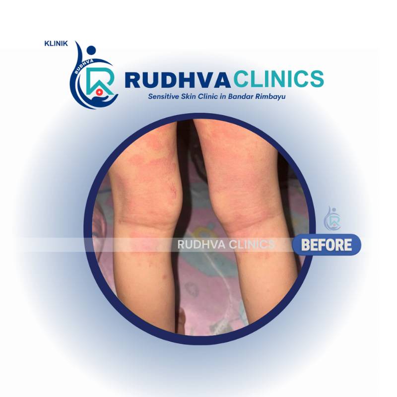RUDHVA - Allergy Services (2)