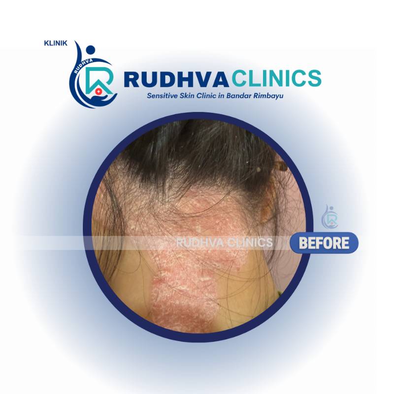 RUDHVA - Eczema Services (1)