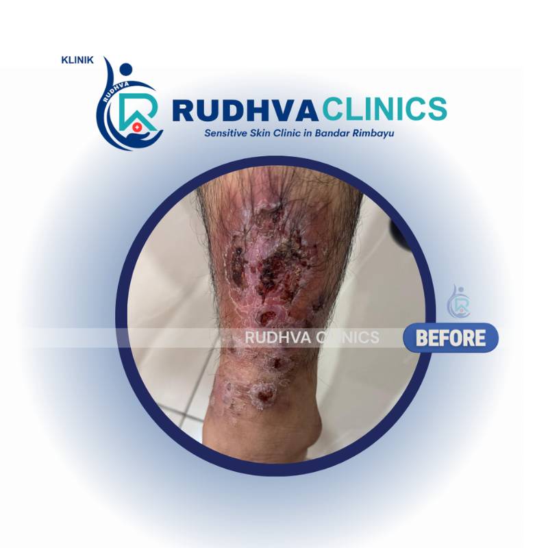 RUDHVA - Eczema Services (2)