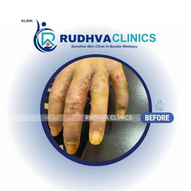 RUDHVA - Skin Infection Services (1)