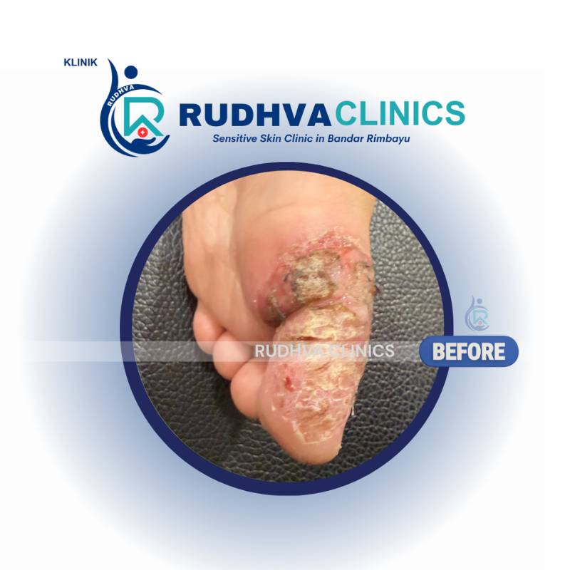 RUDHVA - Skin Infection Services (2)
