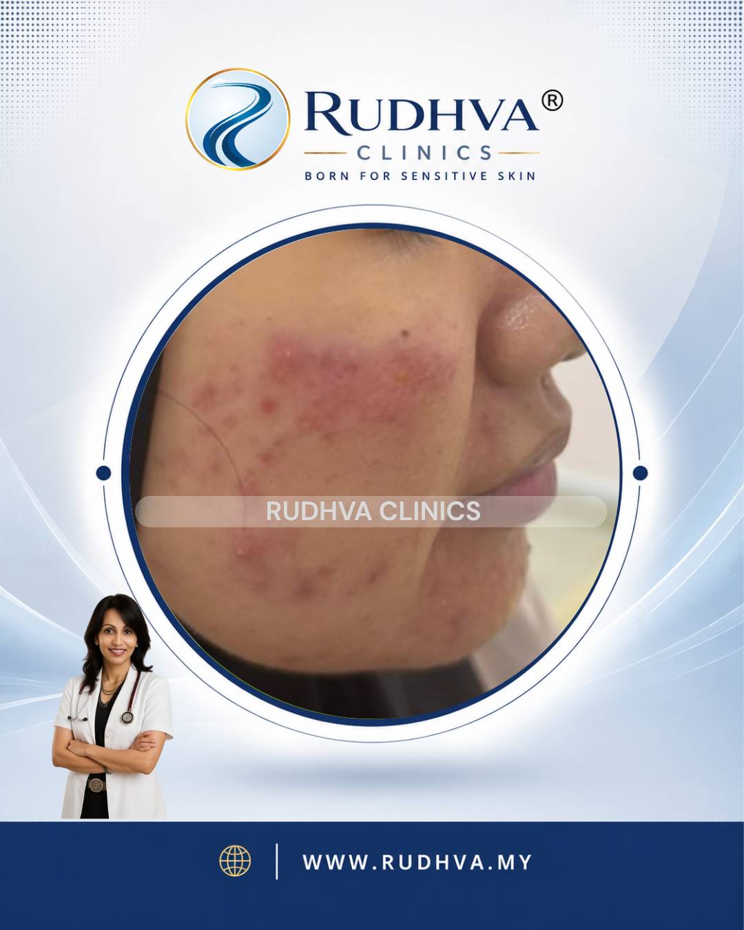 Rudhva - Acne Treatment 1