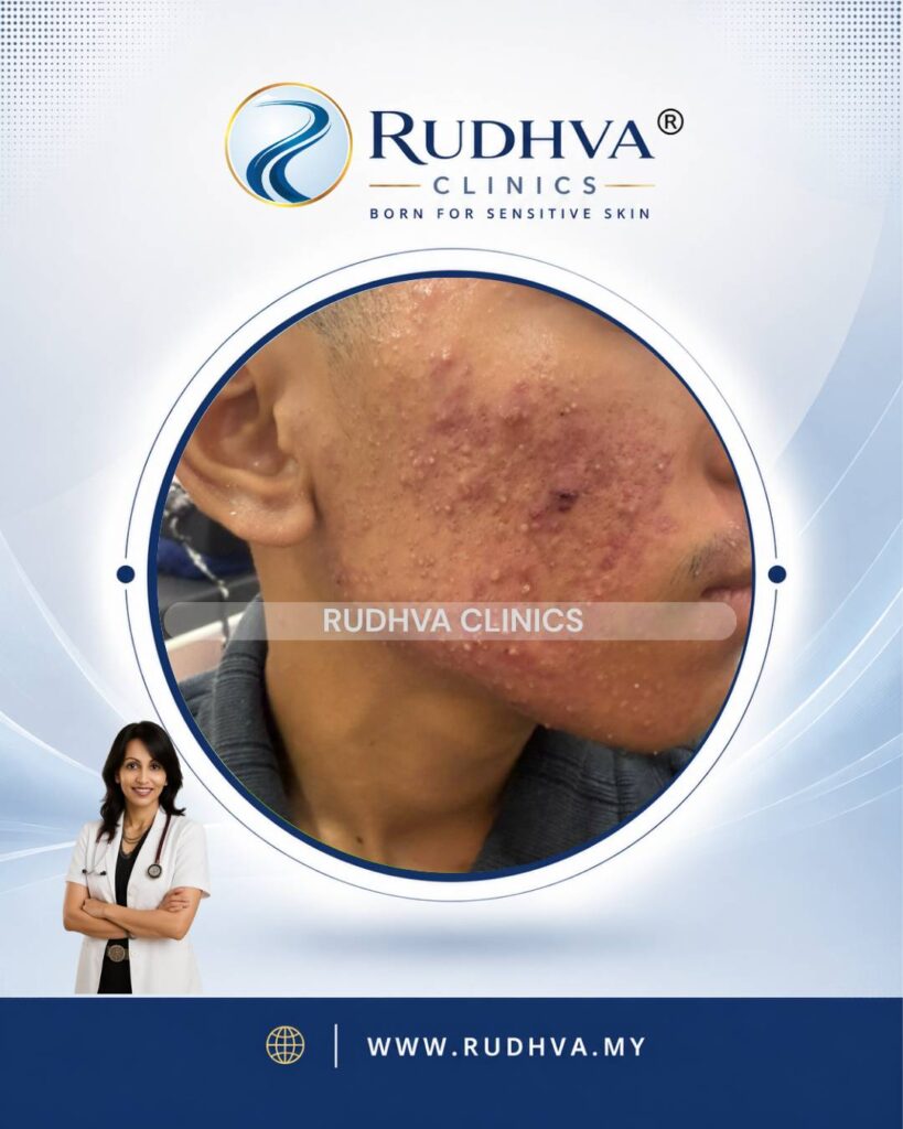 Rudhva - Acne Treatment 2