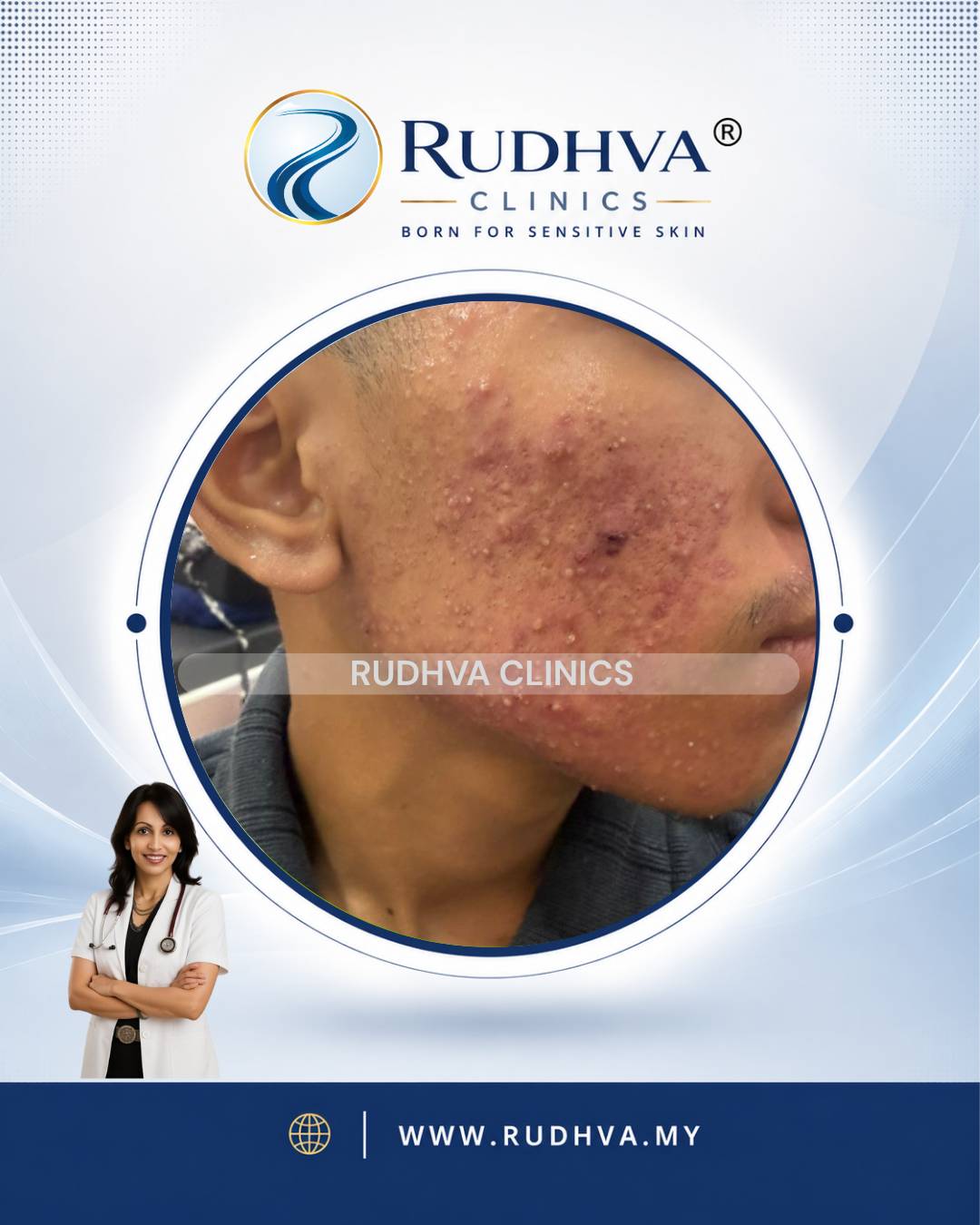 Rudhva - Acne Treatment 2