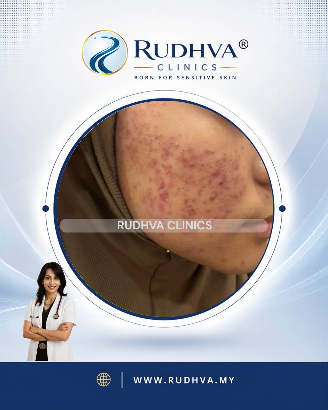 Rudhva - Acne Treatment 3