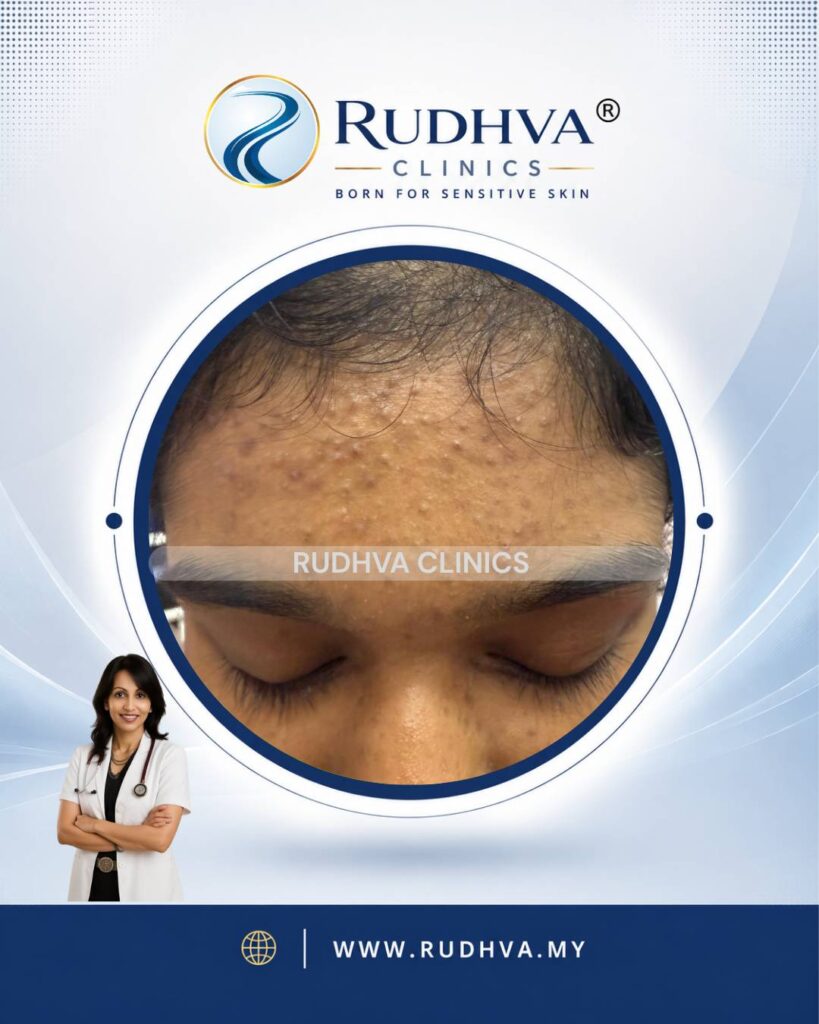 Rudhva - Acne Treatment 4