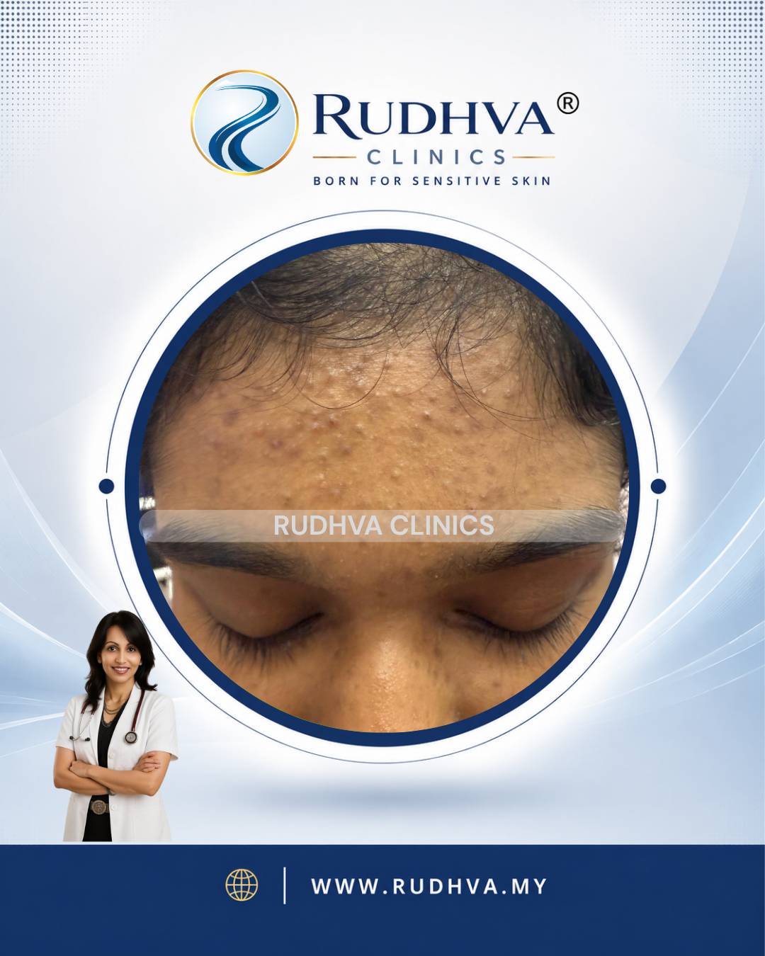 Rudhva - Acne Treatment 4