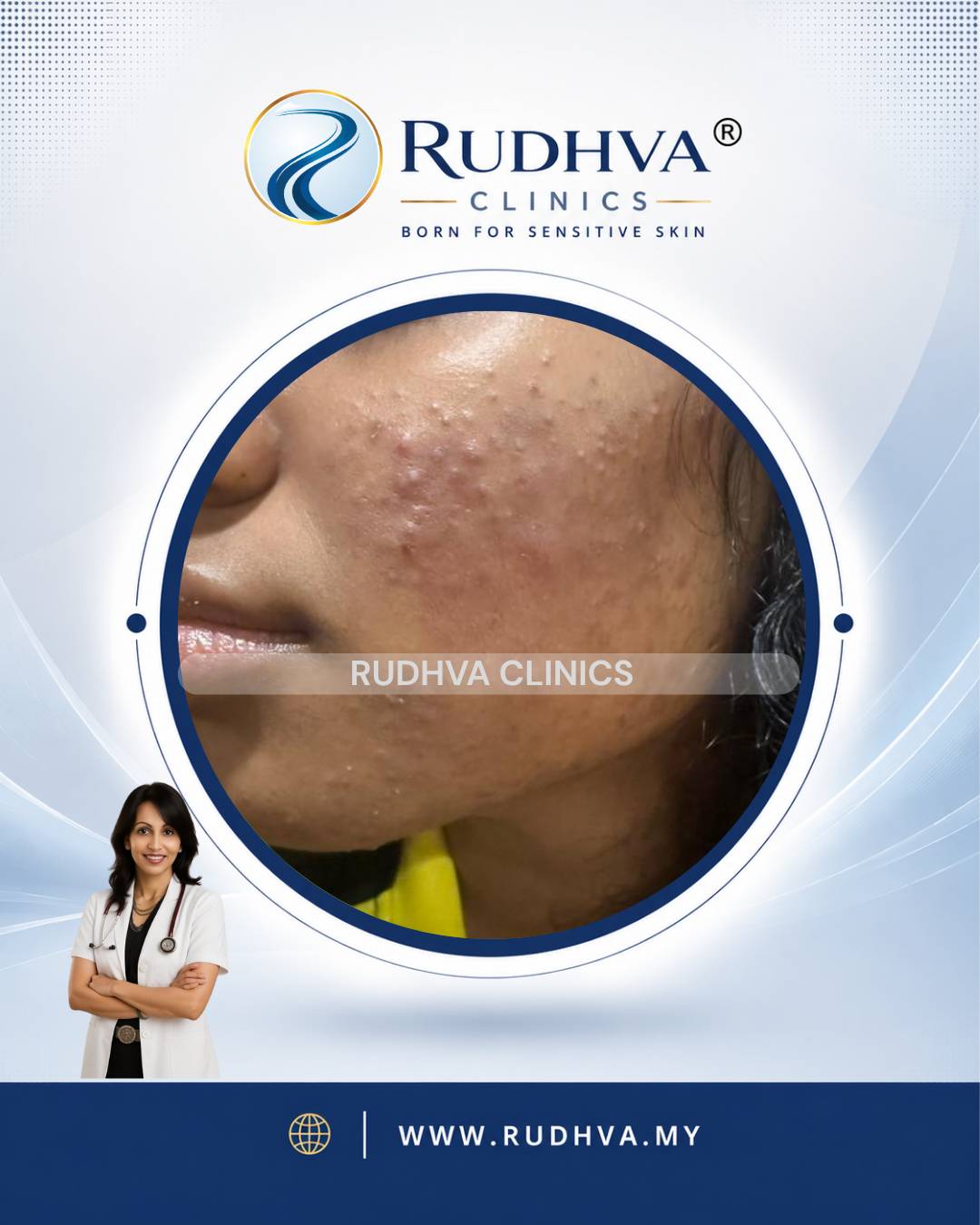 Rudhva - Acne Treatment 5