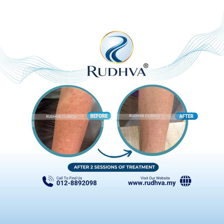 Rudhva - Before & After (Adult) 1