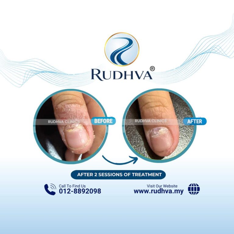 Rudhva - Before & After (Adult) 2