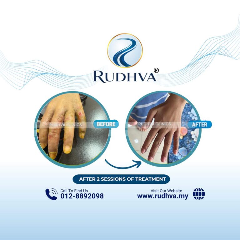 Rudhva - Before & After (Adult) 3