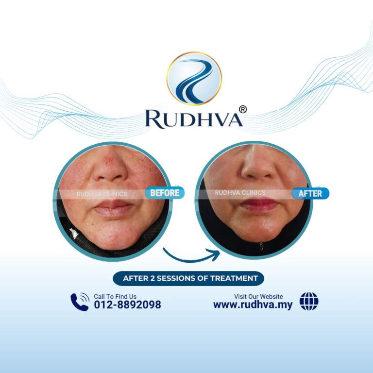 Rudhva - Before & After (Adult) 4