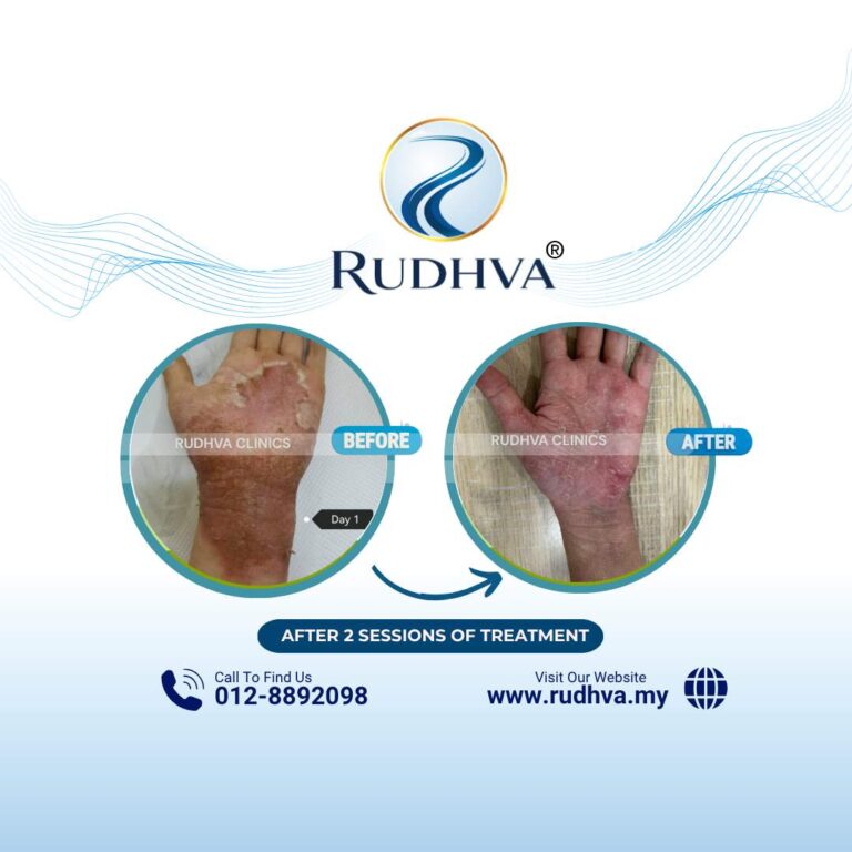 Rudhva - Before & After (Adult) 5