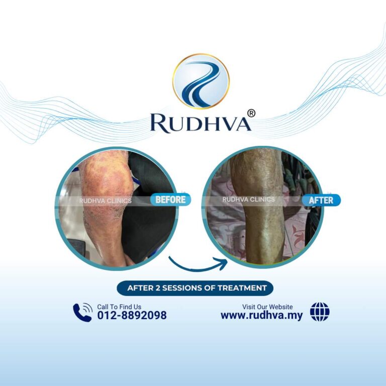 Rudhva - Before & After (Adult) 6