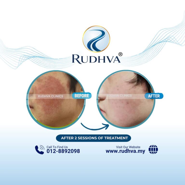 Rudhva - Before & After (Adult) 7