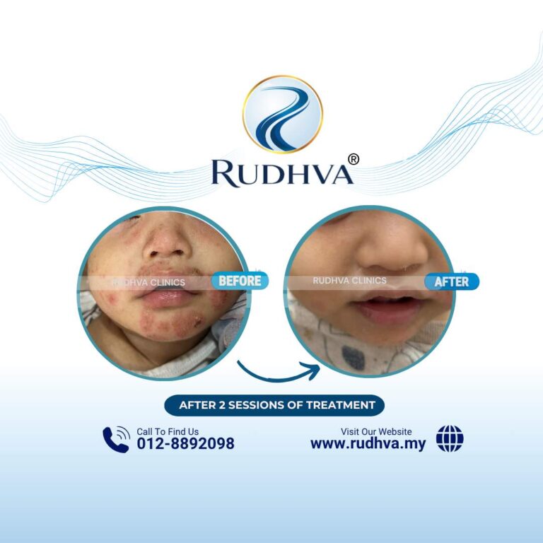 Rudhva - Before & After (Child) 1