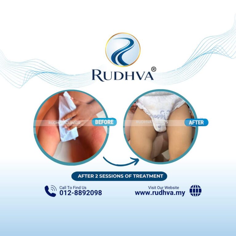Rudhva - Before & After (Child) 2