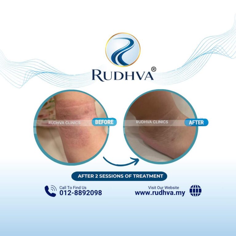 Rudhva - Before & After (Child) 3