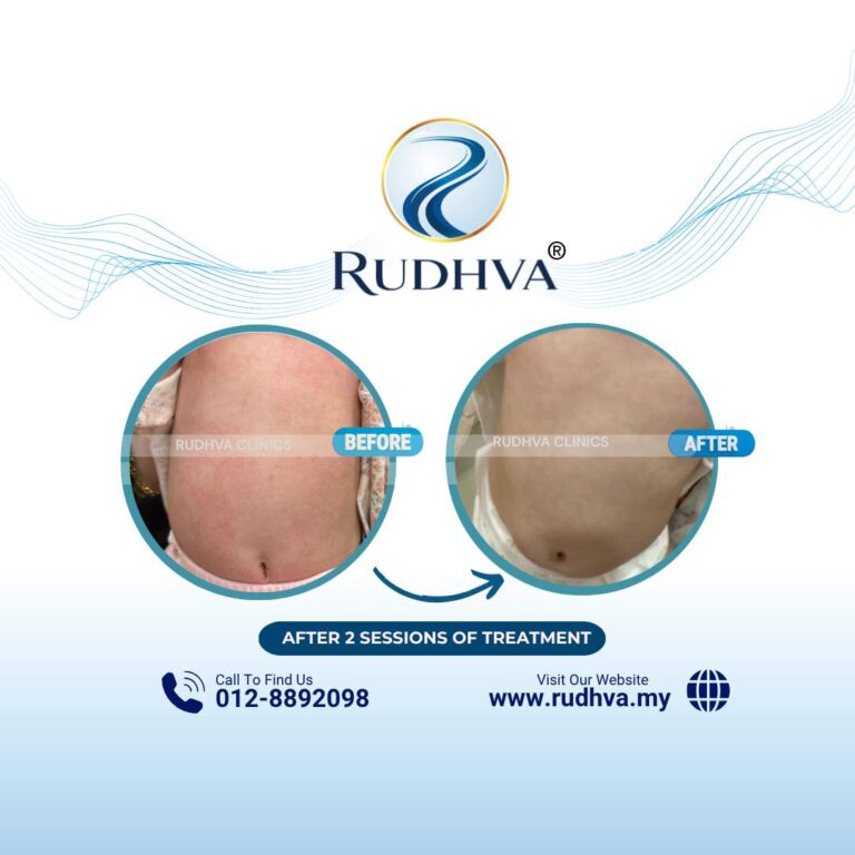 Rudhva - Before & After (Child) 4
