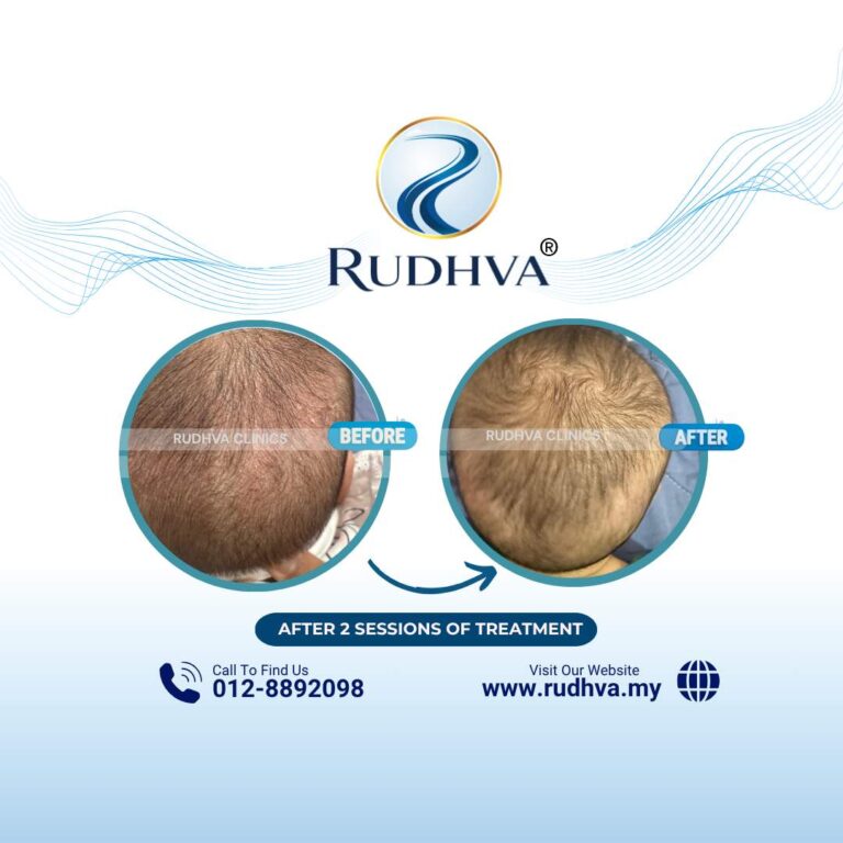 Rudhva - Before & After (Child) 5