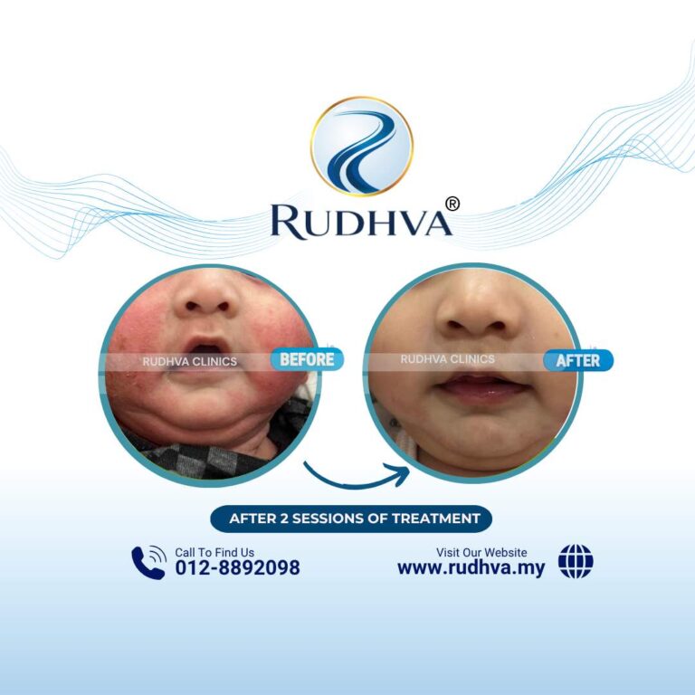 Rudhva - Before & After (Child) 8