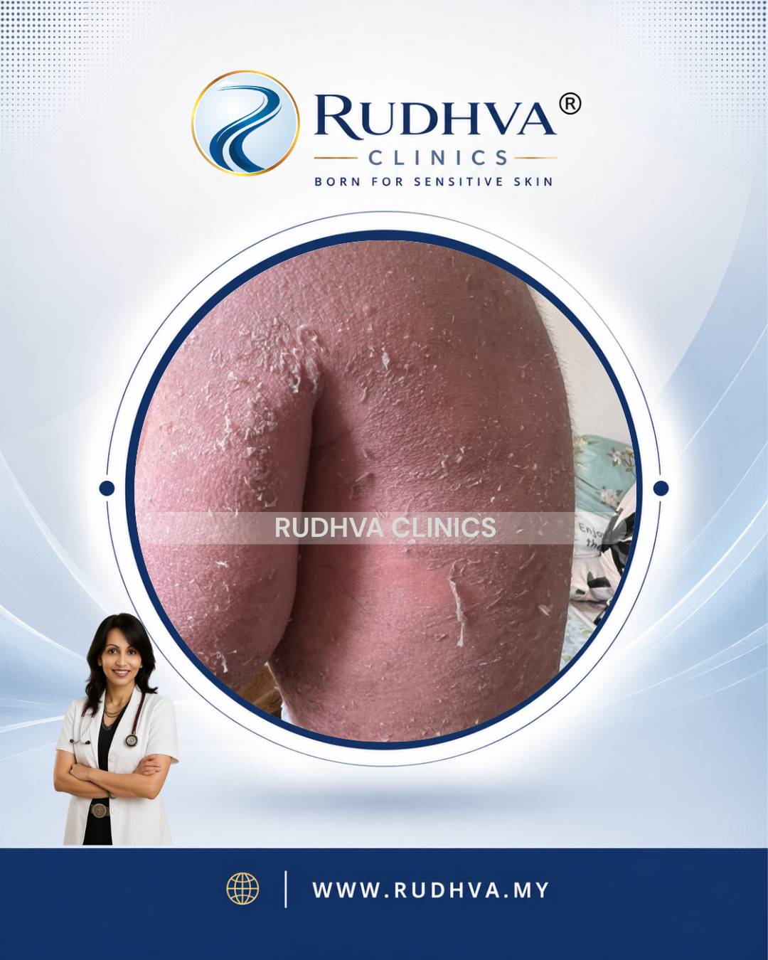 Rudhva - PEDIATRIC DERMATOLOGY 4