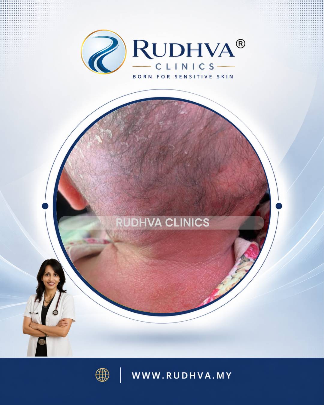 Rudhva - PEDIATRIC DERMATOLOGY 5
