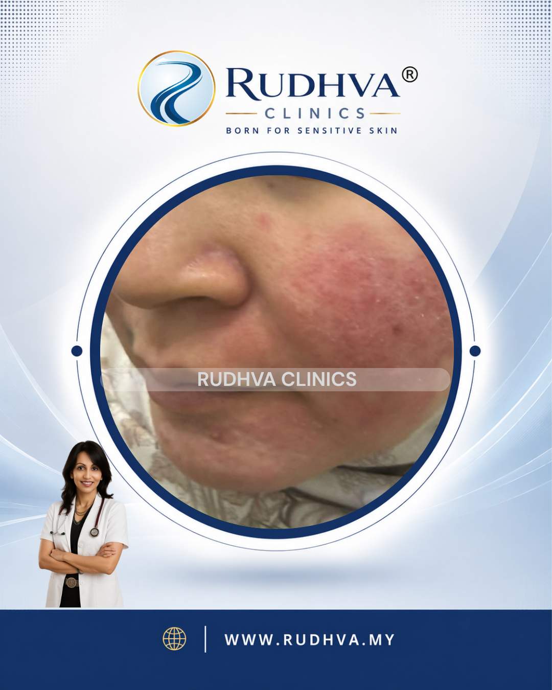 Rudhva Services - Eczema 1