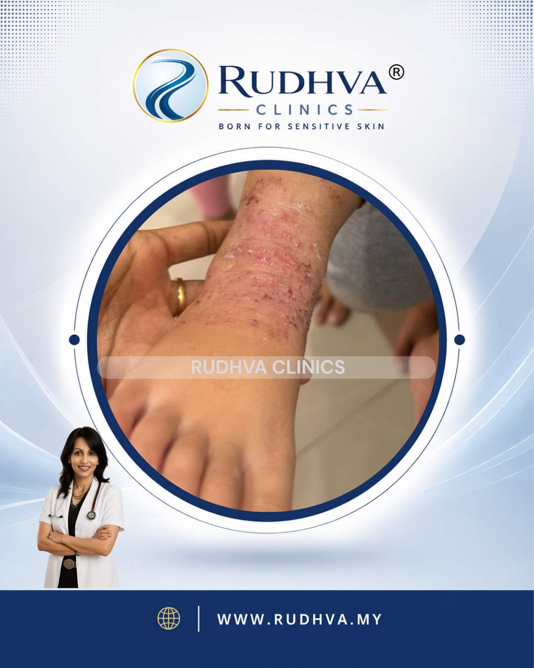 Rudhva Services - Eczema 2