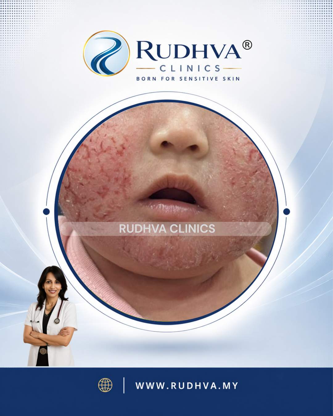 Rudhva Services - Eczema 3