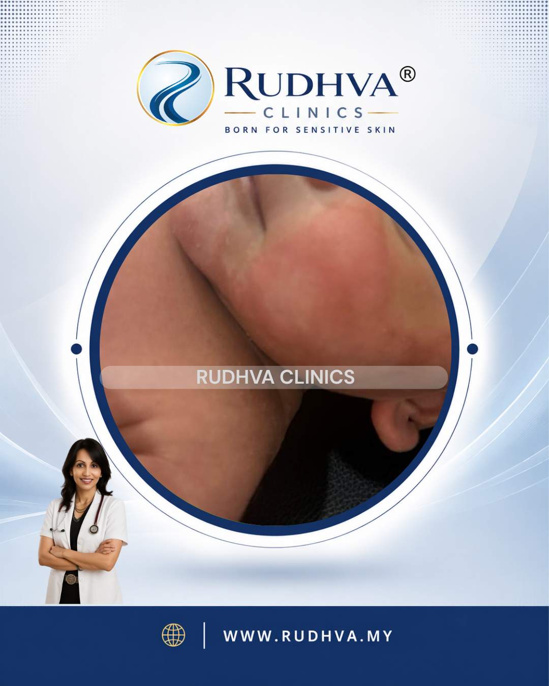 Rudhva Services - Eczema 4