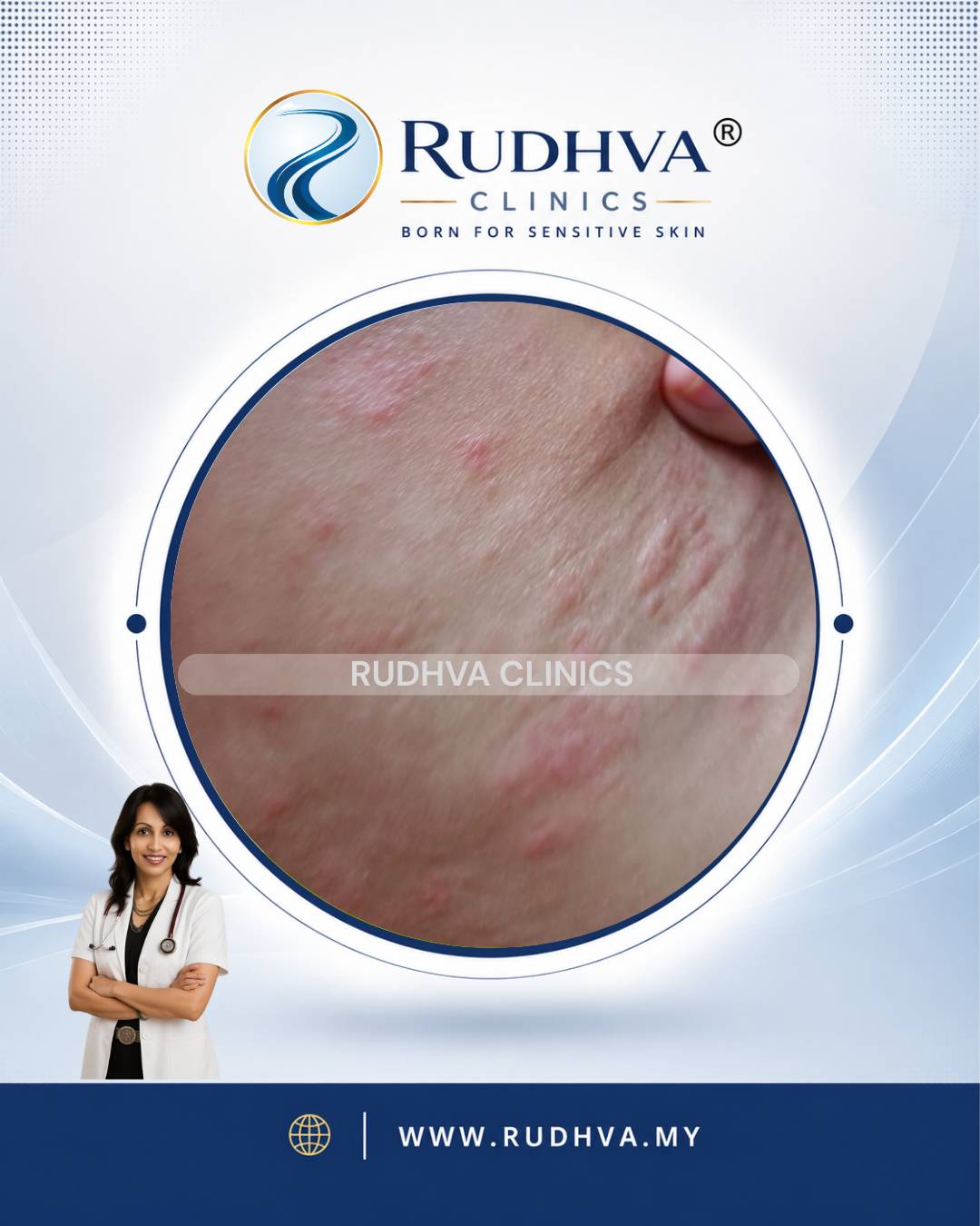 Rudhva - Skin Allergy 1