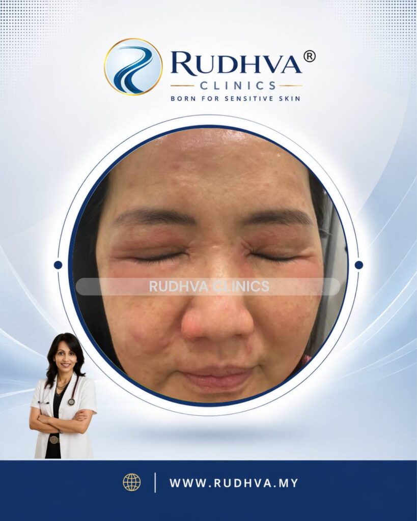 Rudhva - Skin Allergy 2