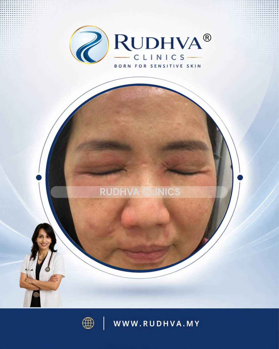 Rudhva - Skin Allergy 2
