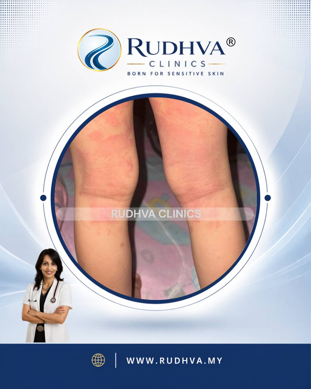 Rudhva - Skin Allergy 4