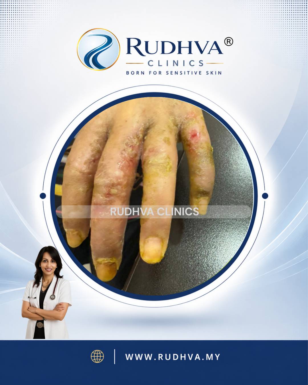 Rudhva - Skin Infection 1