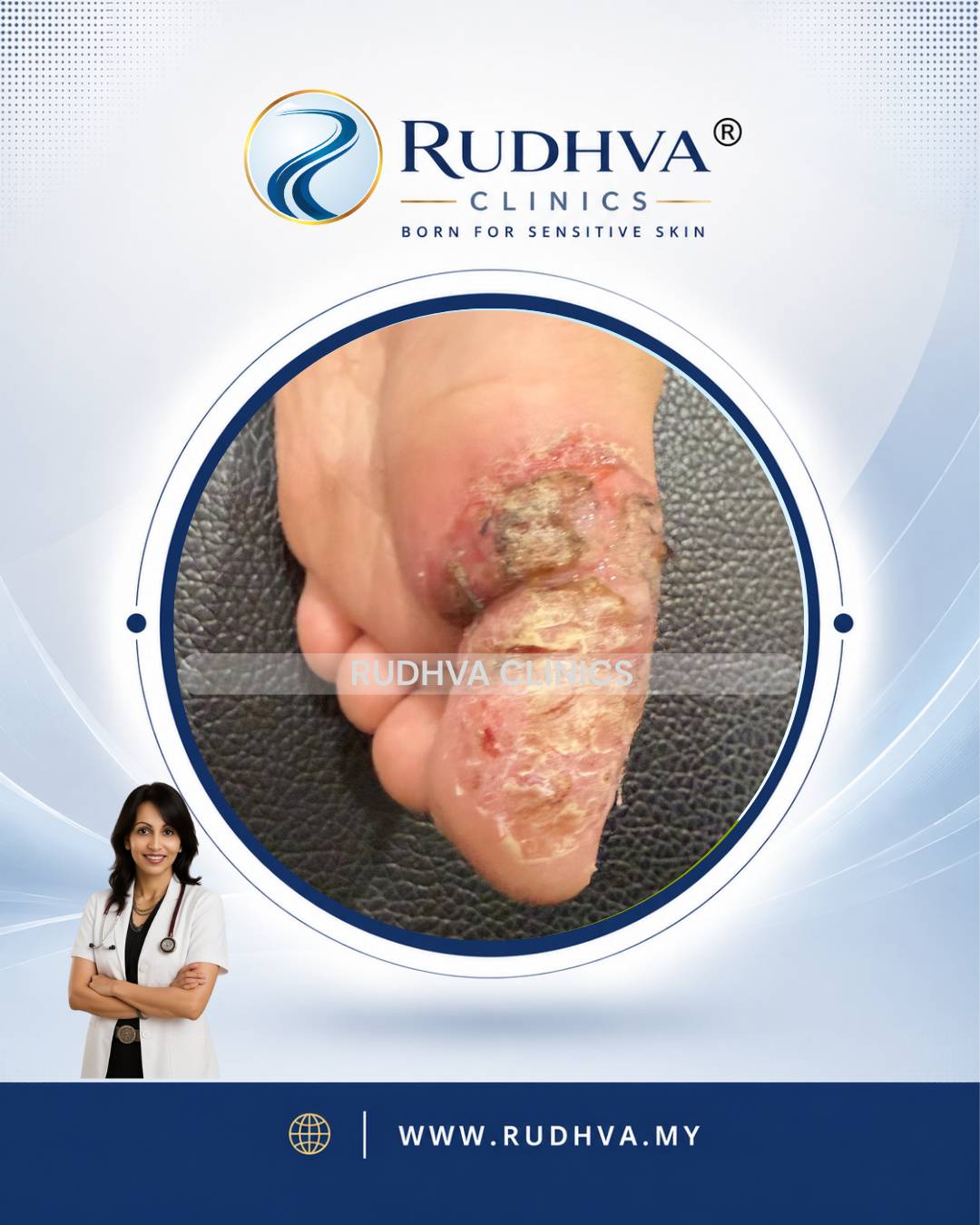 Rudhva - Skin Infection 2