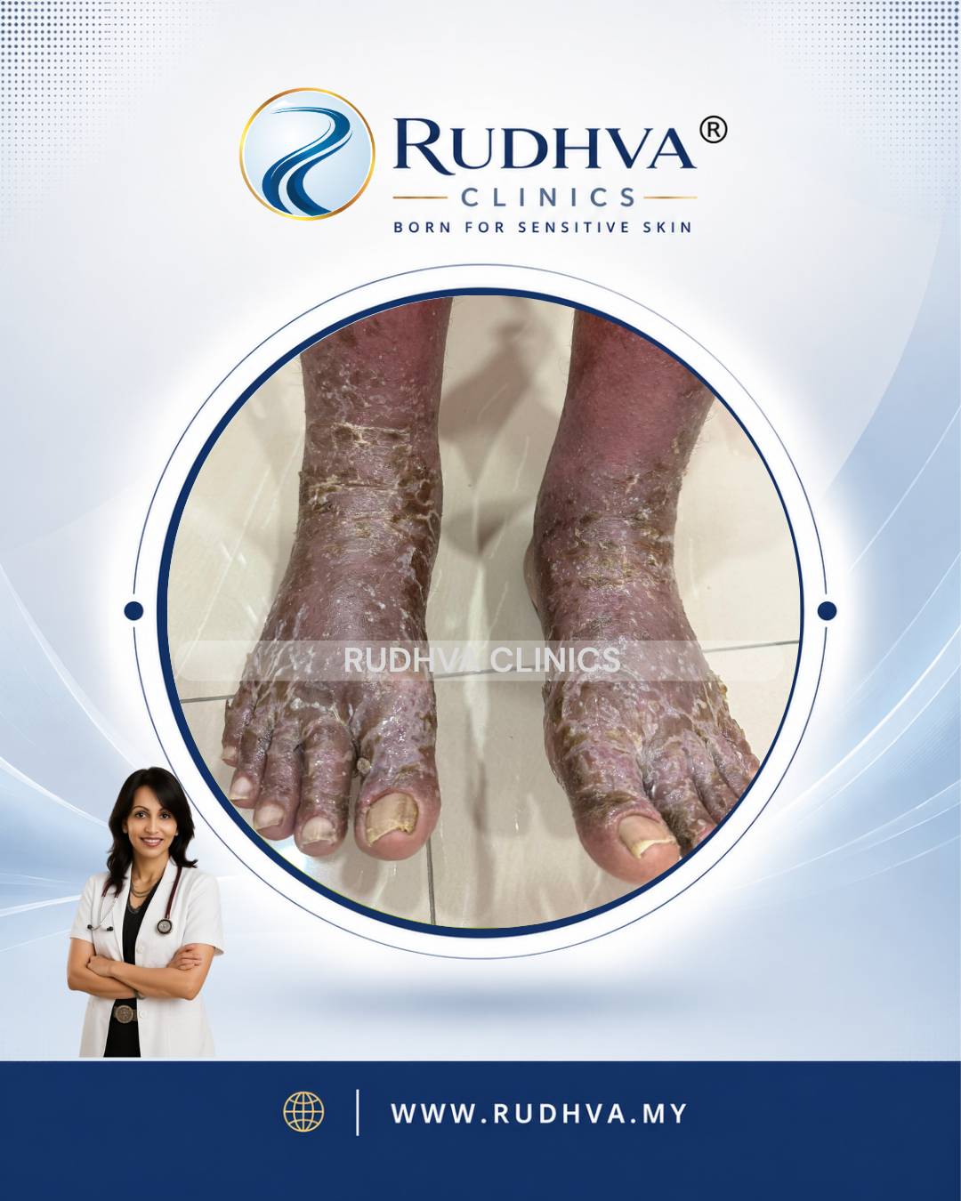 Rudhva - Skin Infection 4