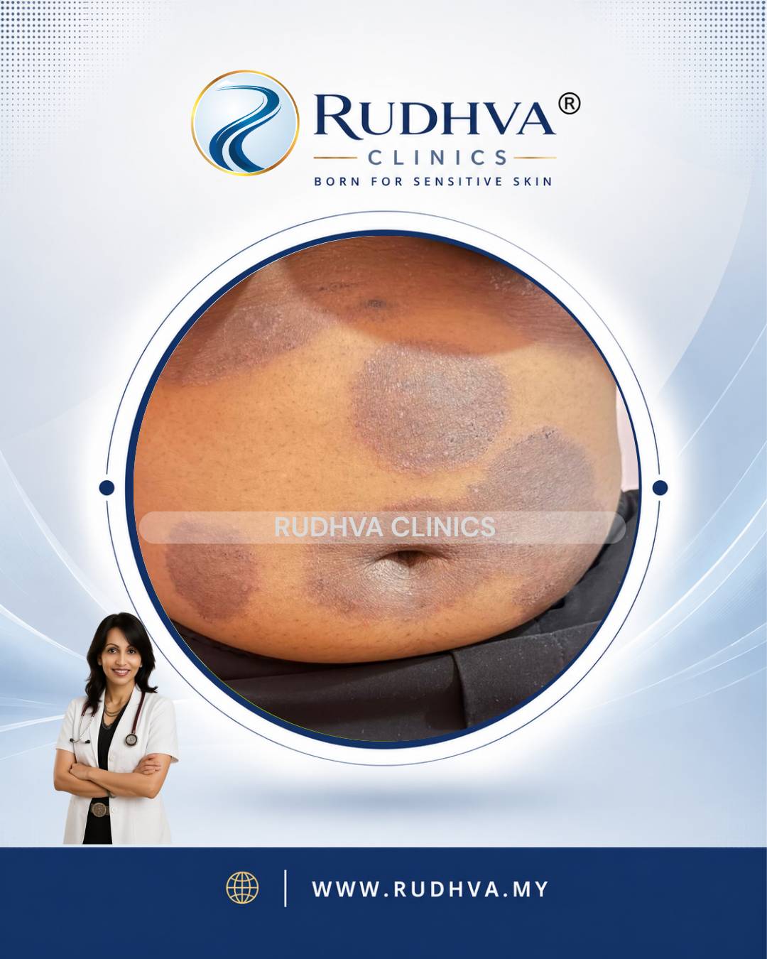 Rudhva - Skin Infection 5
