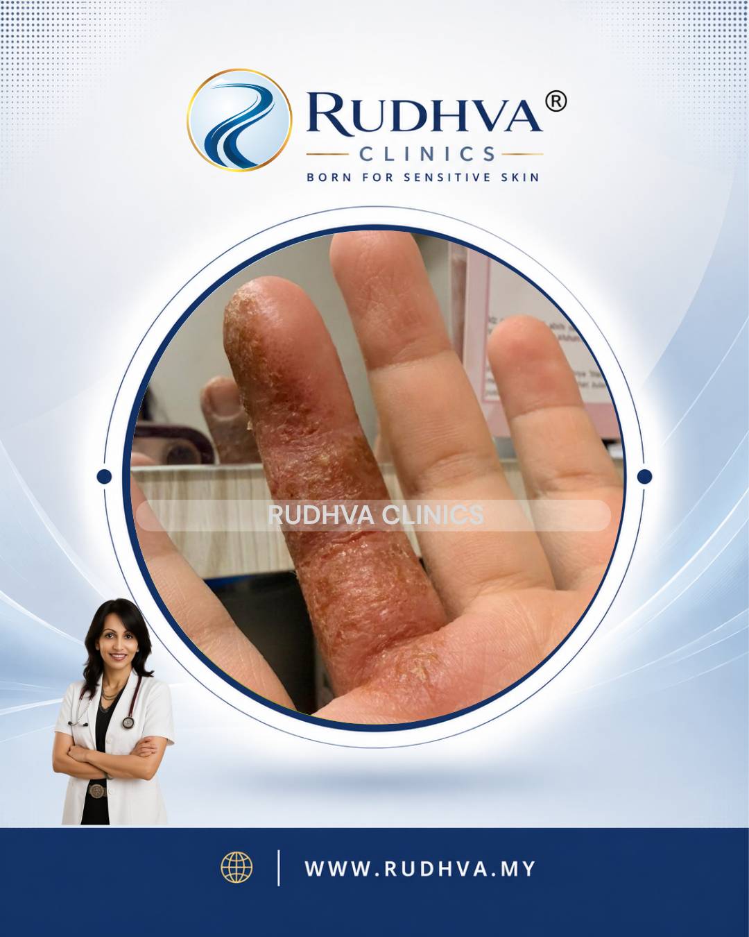 Rudhva - Skin Infection 6
