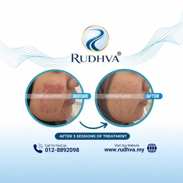 Acne Treatment Testimoni - Rudhva Clinics (1)