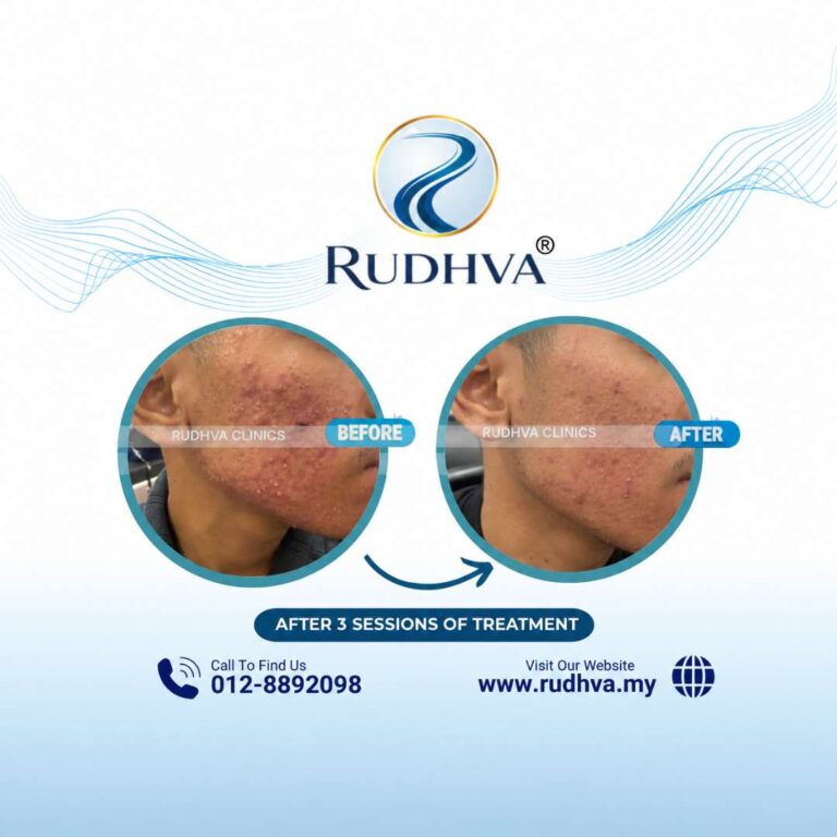 Acne Treatment Testimoni - Rudhva Clinics (2)