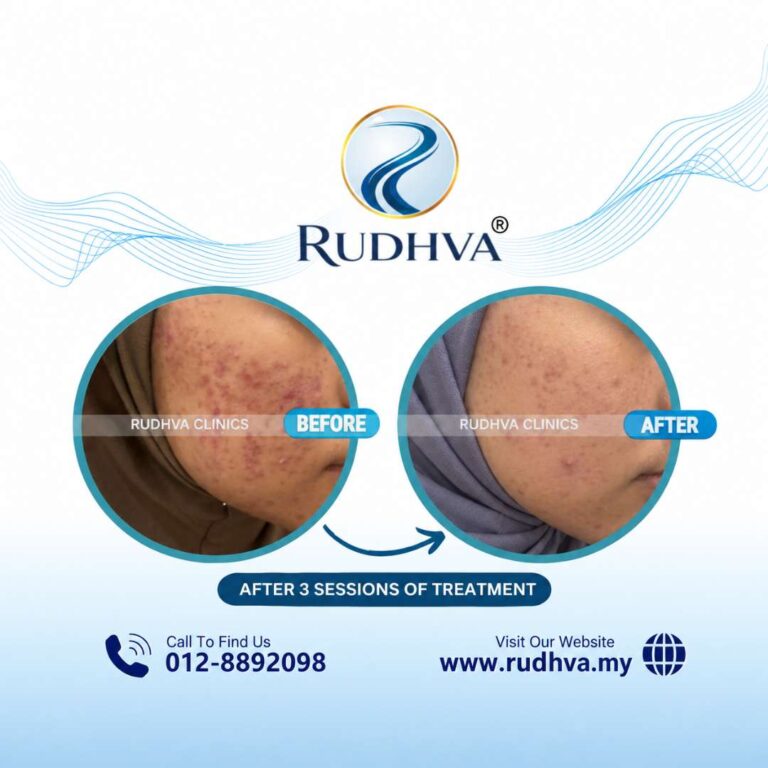 Acne Treatment Testimoni - Rudhva Clinics (3)