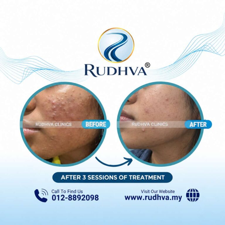 Acne Treatment Testimoni - Rudhva Clinics (4)